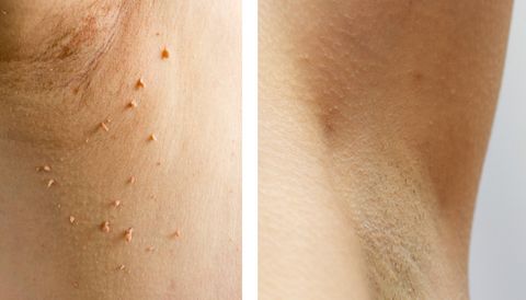 CRÈME CONTRE VERRUES & TACHES